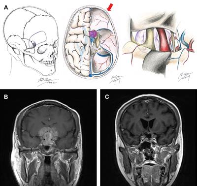 Surgical Experience of Transcranial Approaches to Large-to-Giant Pituitary Adenomas in Knosp Grade 4